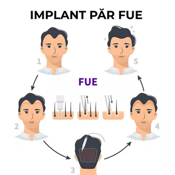 Ce este un implant de păr FUE