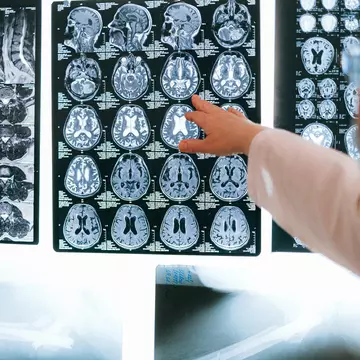 Afecțiunile neurologice: 9 semnale de alarmă