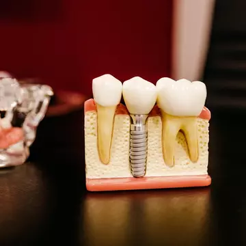 6 motive pentru care merită să apelezi la implanturi dentare