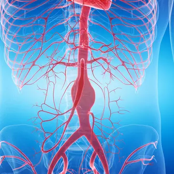 Tot ce trebuie să știi despre anevrismele de aortă, una dintre cele mai subdiagnosticate afecțiuni