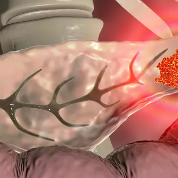 Studiu: un virus modificat genetic poate ajuta la combaterea cancerului pancreatic avansat