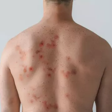 Patru cazuri de variola maimuței în România. Al patrulea pacient este internat