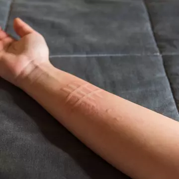 Ce este dermografismul și care sunt cauzele acestuia