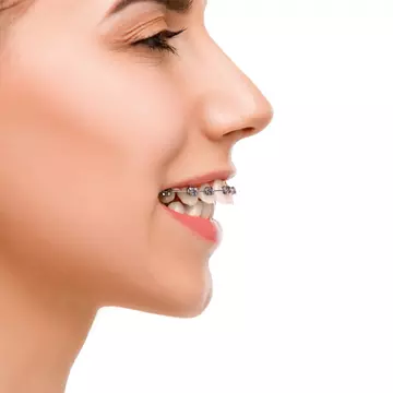 8 celebrități care au purtat aparat dentar