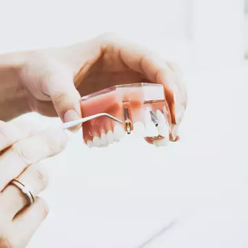 Ce sunt implanturile dentare și cum funcționează?
