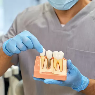 Ce este un implant dentar și când ai nevoie de el?