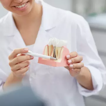 Implanturi dentare în timp record: cum să obții o dantură completă într-o singură zi
