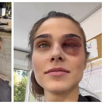 Theo Rose, cu ochiul vânăt și umflat: „Am petrecut câteva zile cu ochiul închis”. Cum a reacționat Anghel Damian / Video