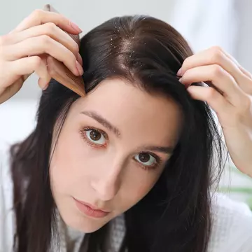 9 semne care indică prezența dermatitei seboreice