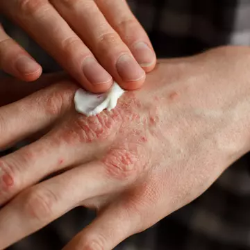 Psoriazisul și dermatita seboreică: simptome și puncte comune