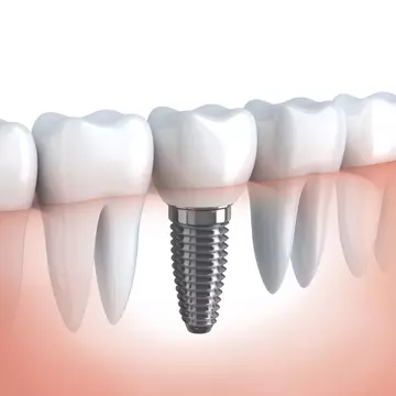Care este diferența între un implant dentar și o punte dentară?