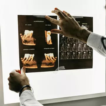 Implanturile dentare – cea mai bună soluție pentru înlocuirea dinților lipsă