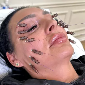 Transformare fără bisturiu: liftingul facial cu fire resorbabile