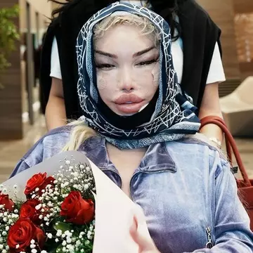 Jessica Alves, desfigurată după ce și-a făcut o nouă intervenție estetică la față. "Doctorul a putut să-mi îndepărteze cinci centimetri din piele"