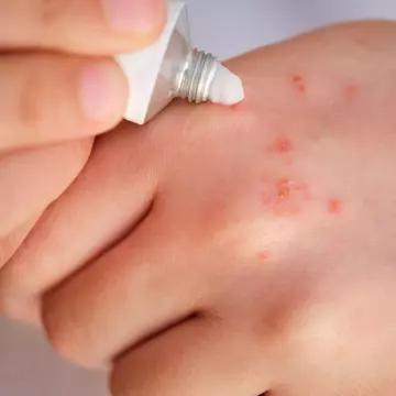 Rutina zilnică de îngrijire pentru pielea atopică