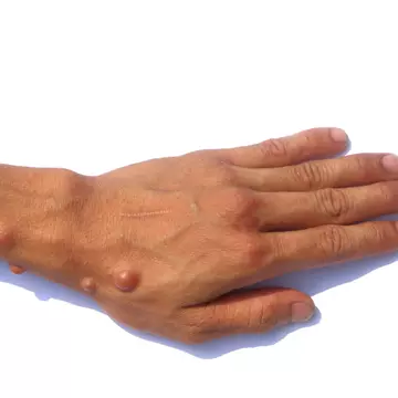 Cum gestionezi neurofibromatoza? Echipa de care ai nevoie.
