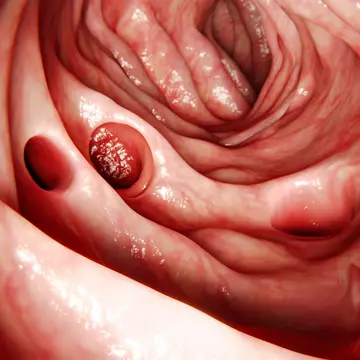 Diverticuloza colonică, o afecțiune mai frecventă decât ne imaginăm