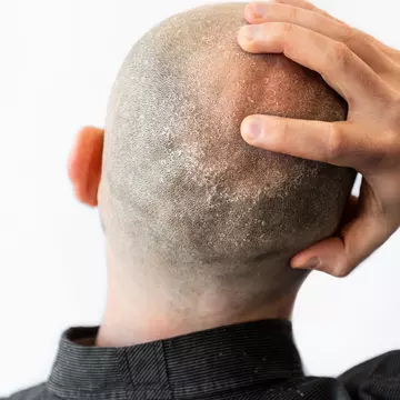 Ce este dermatita seboreică, de ce apare și cum o tratăm