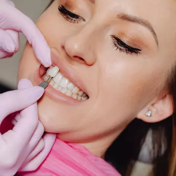 Cum alegi nuanța potrivită pentru fațetele dentare