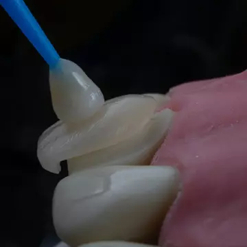Cum se îngrijesc corect fațetele dentare