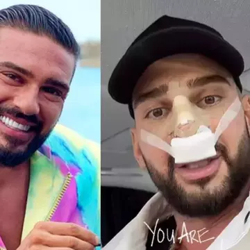 Dorian Popa a fost operat de urgență la nas. Intervenția chirurgicală a durat 6 ore: „Mi-a scos din coastă o bucată de vreo 5 cm. Aveam osul spină lipsă”