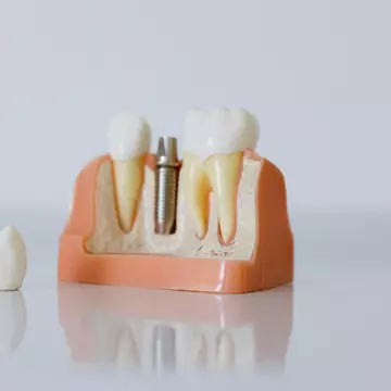 Implant dentar preț - de ce nu ar trebui să alegi doar în funcție de cost