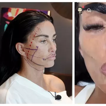 Katie Price, de nerecunoscut după cea mai recentă intervenție la nivelul feței. "Buzele mele par atât de subțiri, urăsc asta!"