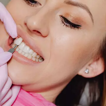 Ce se întâmplă cu fațetele dentare după zece ani