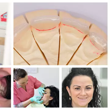 Atelierul de Zâmbete explică de ce păstrarea structurii naturale a dintelui contează în estetica dentară