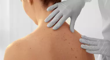 Cum recunoști cele mai comune tipuri de cancer de piele