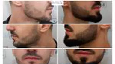 Barbă rară sau neuniformă? Ce trebuie să știi despre transplantul de barbă și prețul acestuia?
