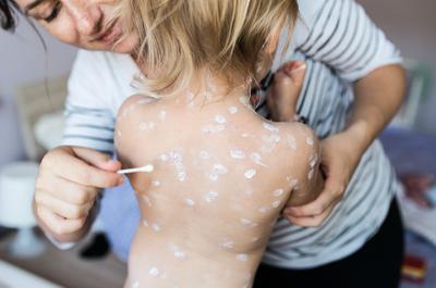 Val de cazuri de varicelă la adulți în 2026. De ce boala „copilăriei” a devenit un pericol letal la maturitate