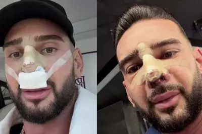 Cum arată nasul lui Dorian Popa la 12 zile de la operație. Și-a dat bandajul jos: „Cum nici nu am visat”