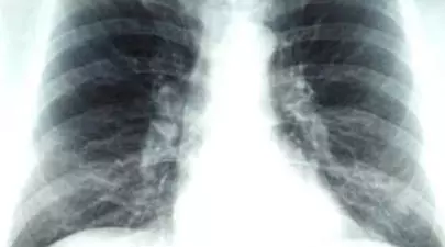 România, „premianta” Europei la tuberculoză