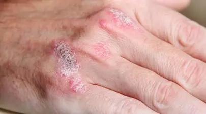 Să fii atins de psoriazis nu înseamnă să nu mai poţi fi atins