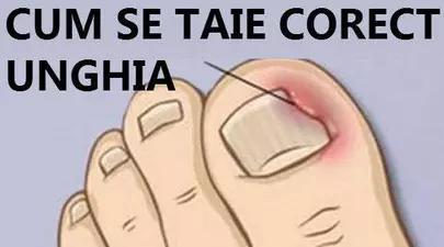 Cum tratezi unghiile încarnate