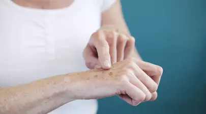 Cum să scapi de petele pigmentare de pe mâini, folosind un remediu natural