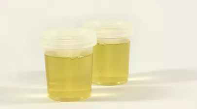 Arsura la urinare