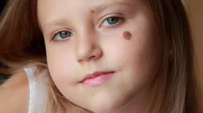 S-a născut cu peste 500 de semne pe corp și era poreclită „Dalmațiana”. Cum arată acum adolescenta care a devenit model