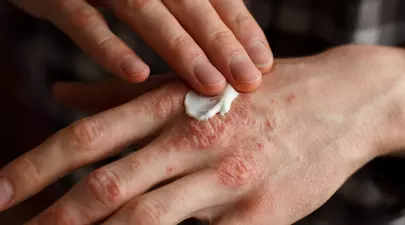 Psoriazisul și dermatita seboreică: simptome și puncte comune