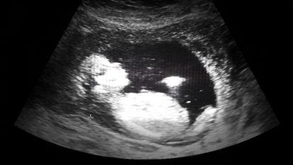 Povestea unui avort la 17 saptamani de sarcina
