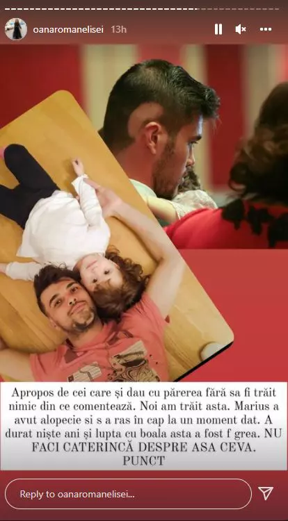 marius-elisei-alopecie-7