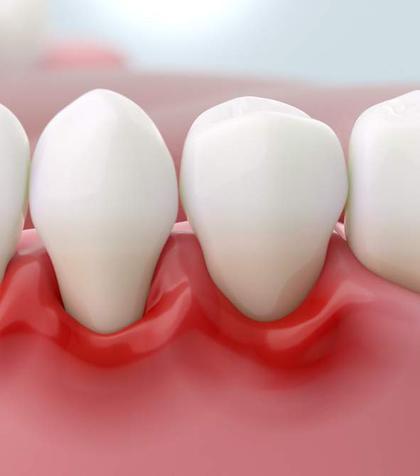 Tratamente naturiste pentru gingivită: ce îți poate calma gingiile inflamate, ce funcționează acasă și când ai nevoie de medic