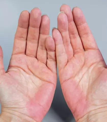 Ce semnificație are culoarea palmelor – ce probleme medicale pot indica