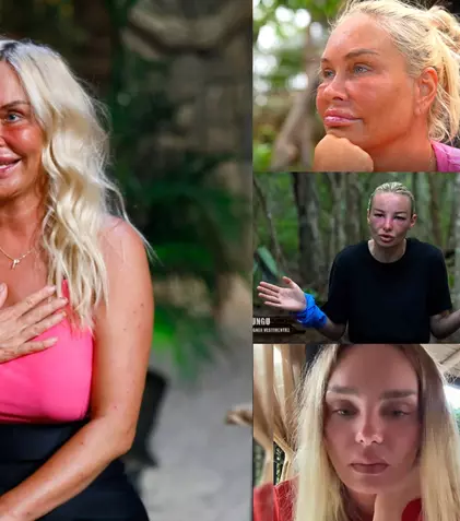 De ce concurentele de la „Survivor” ajung să aibă fața umflată, deși mănâncă doar orez și cocos. Explicațiile medicului