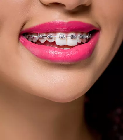 Factori care influențează costul unui aparat dentar