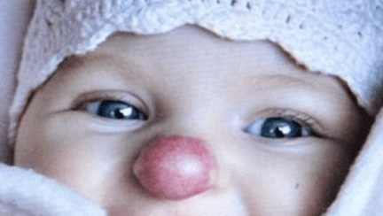 Cum arată astăzi fetița cu "nasul lui Rudolf", născută cu hemangiom. Este adolescentă și a scăpat de complexele din copilărie