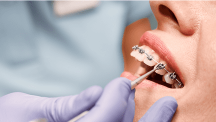 Care sunt cele mai frecvente probleme dentare la adolescenți?