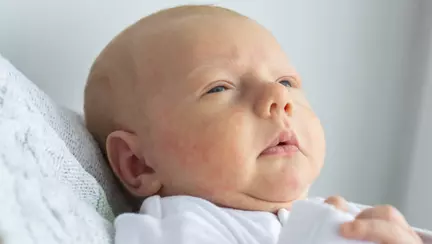 Bolile atopice in copilarie