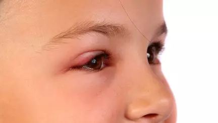 Are pleoapele umflate - de ce?